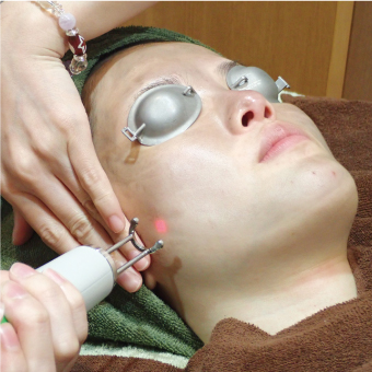 カーボンレーザーピーリング